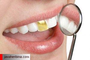 مزايا و معایب طلا در دندانپزشکی