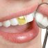 مزايا و معایب طلا در دندانپزشکی