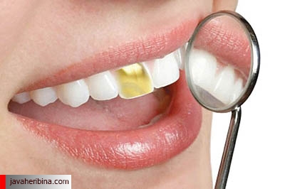 مزايا و معایب طلا در دندانپزشکی