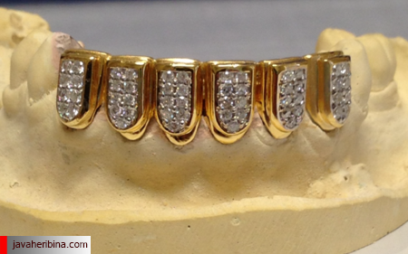 مزایا و معایب طلا در دندانپزشکی